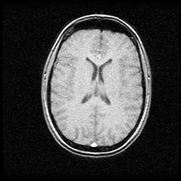 MRI - Axial (Superior)
