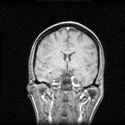 MRI - coronal view

