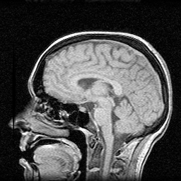 MRI - sagittal view
