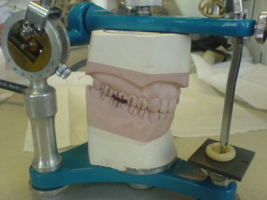 Waxing of the first molar
Sept 19th, 2007
