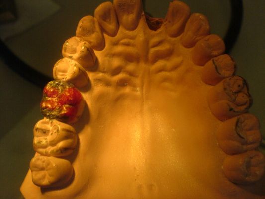 Waxing of the first molar
